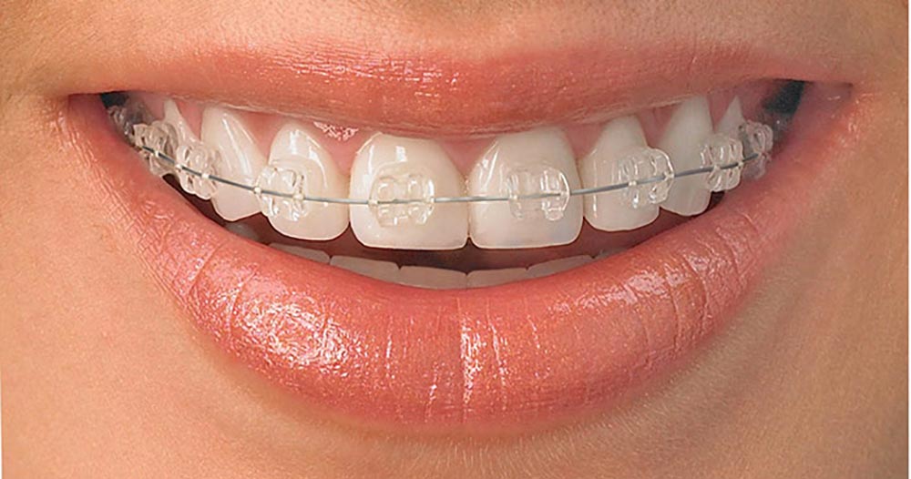 Bild von Zähnen mit keramischer Kieferorthopädie