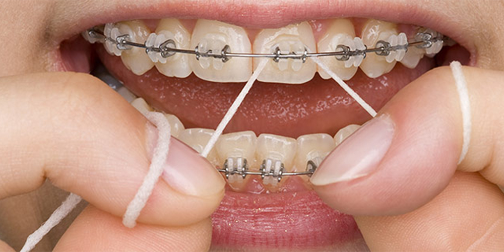 شخصی دارای ارتودنسی ثابت در حال نخ دندان کشیدن