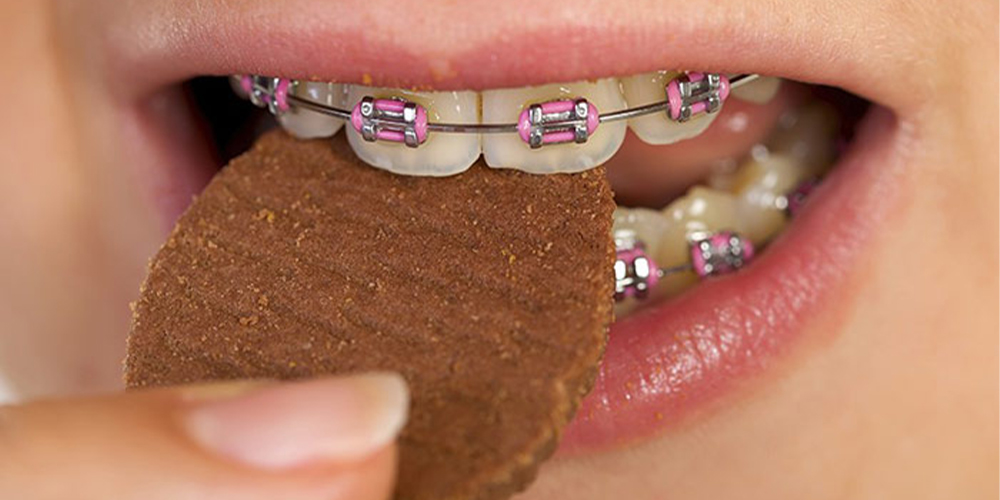 a person with fixed orthodontics eats biscuits