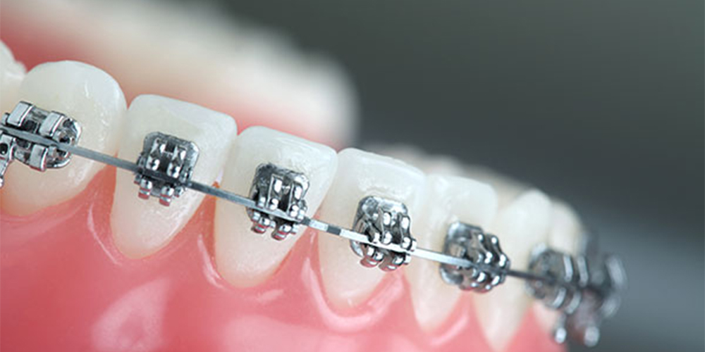 Bild von Zähnen mit festsitzender Kieferorthopädie