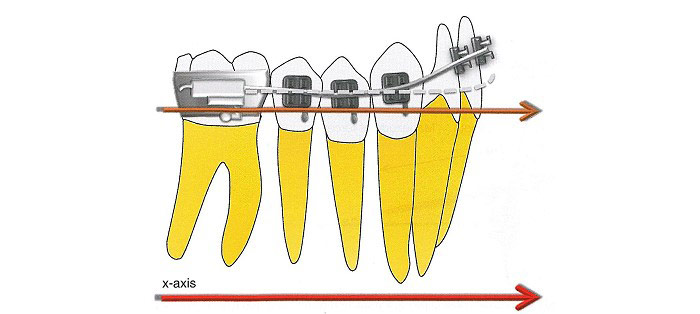 اینتروژن دندان