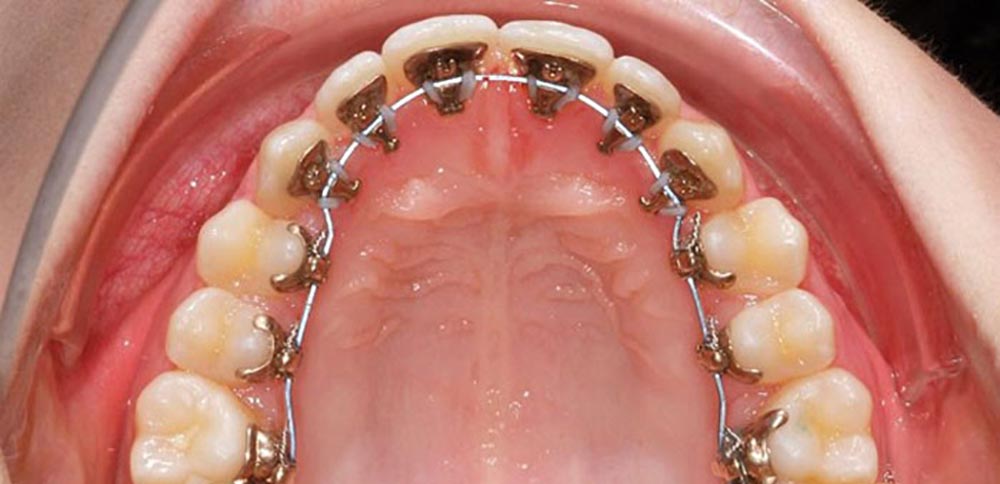 الأسنان مع تقويم الأسنان اللساني