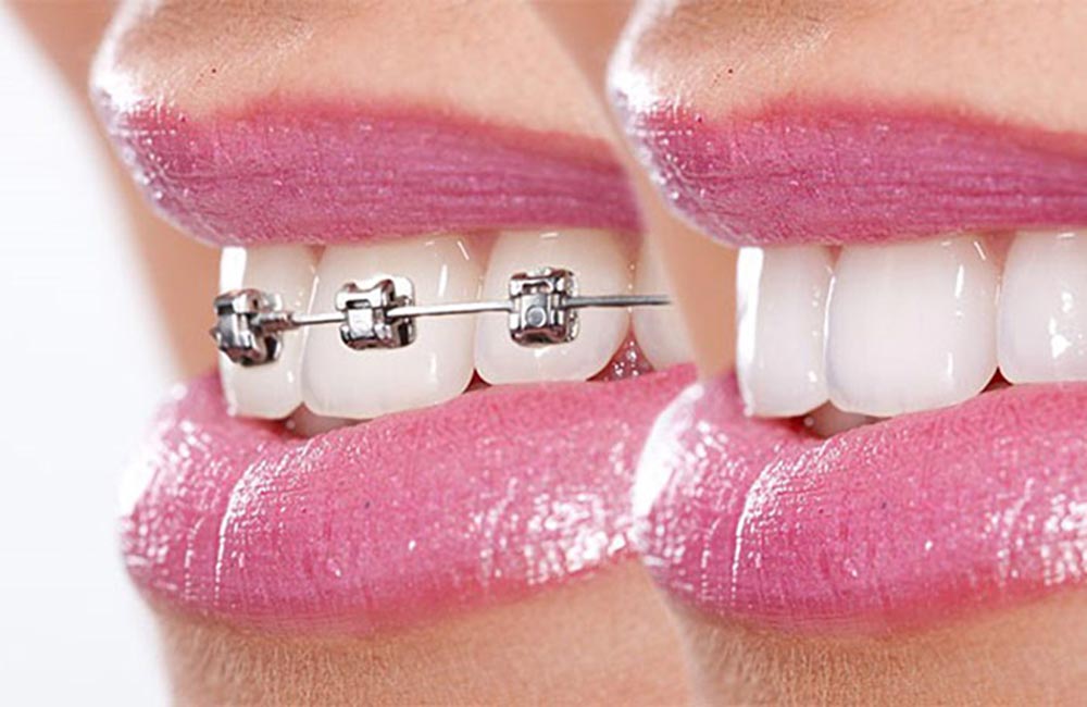 image of aligned teeth with orthodontics