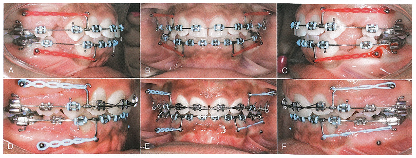ارتودنسی فضای دندانی