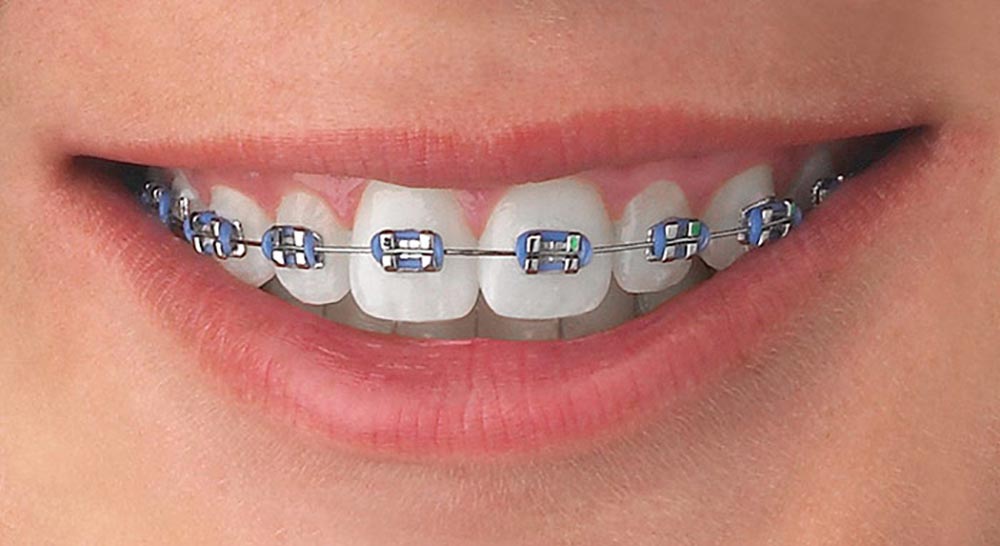 Orthodontic patient smiling with fixed orthodontic brackets