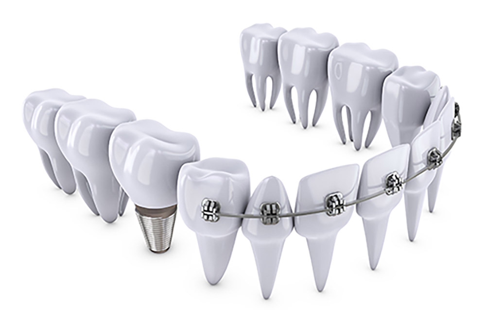 Führen Sie eine kieferorthopädische Behandlung nach der Implantation von Zähnen mit Implantaten durch