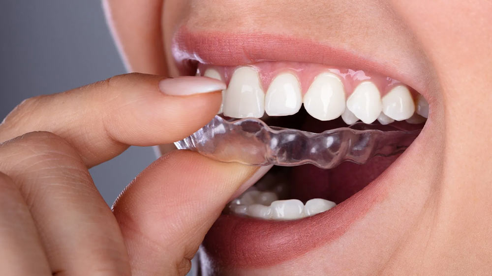 person demonstrating how to put after orthodontics retainer on the teeth