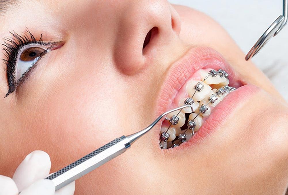 بیماری که برای ردیف کردن دندان ها از ارتودنسی استفاده کرده است
