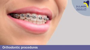 smiling lady undergoing fixed orthodontic treatment