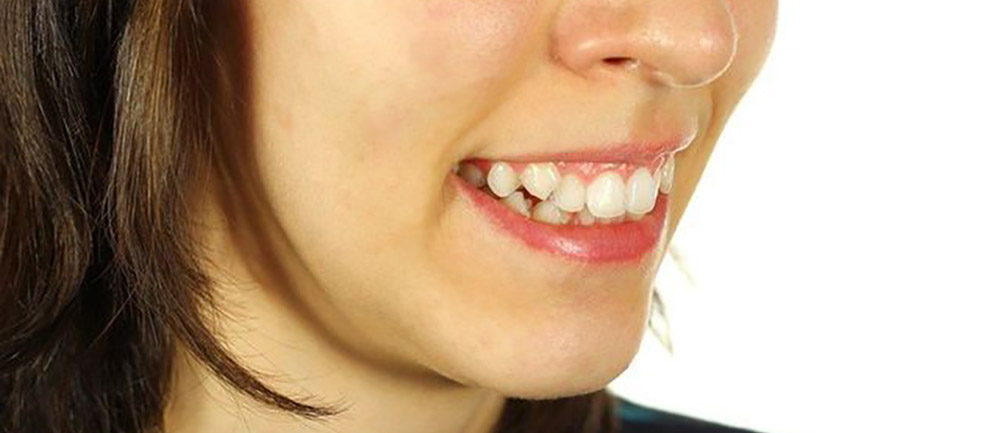 Eine Frau mit schiefen Zähnen