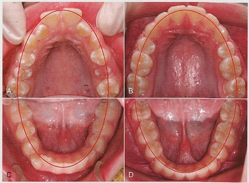 قبل بعد درمان قوس دندانی