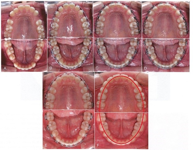 قوس دندانی در طول درمان ارتودنسی