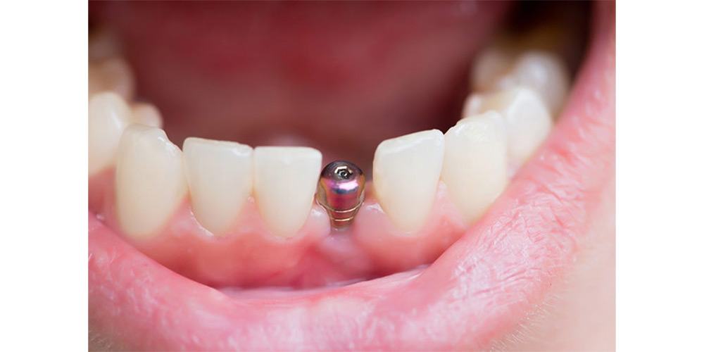 لازمه های ایمپلنت دندانی