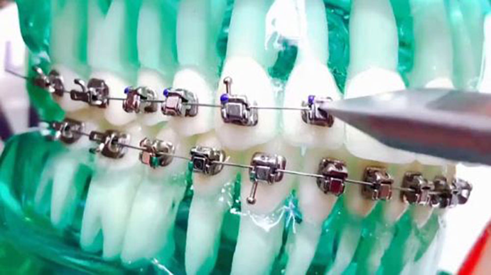 damon orthodontic installation