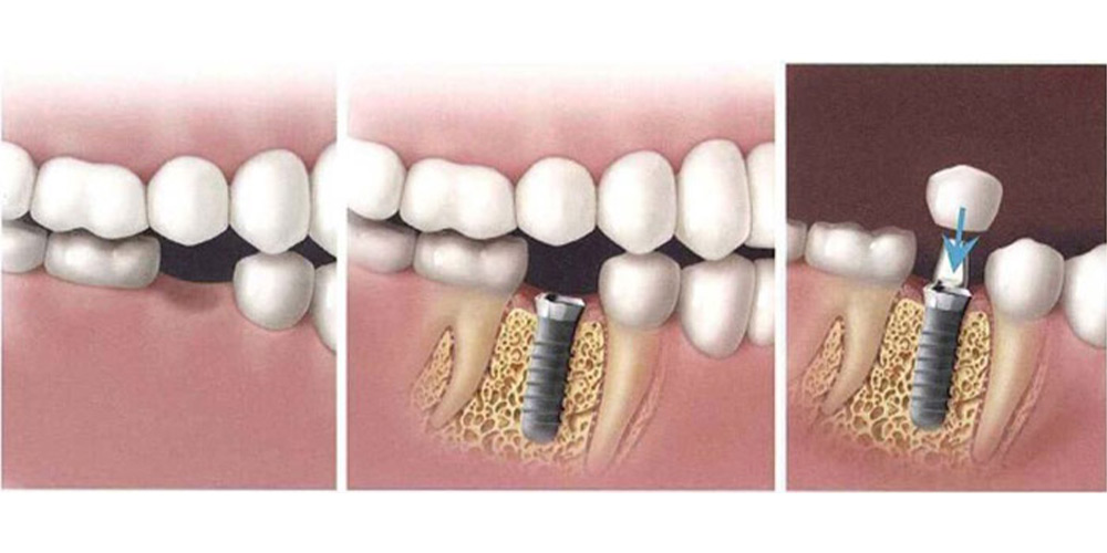 فاصله زمانی بین کشیدن تا ایمپلنت دندان