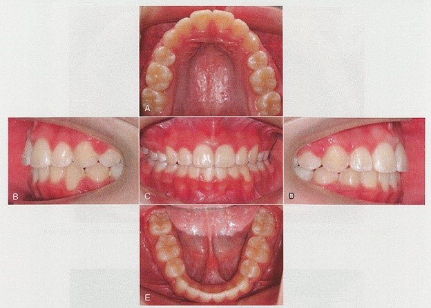 داخل دهان بعد از درمان ارتودنسی