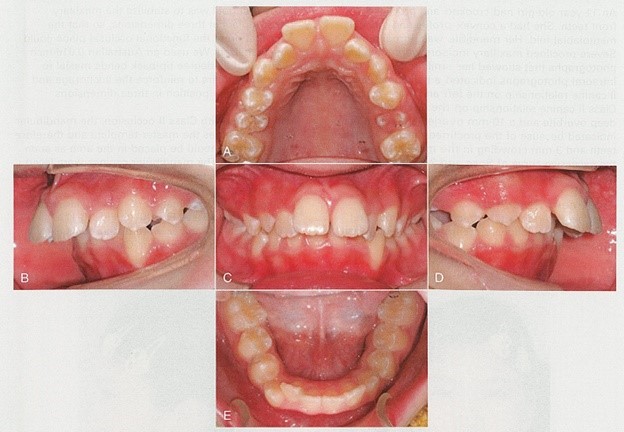 داخل دهان قبل از درمان