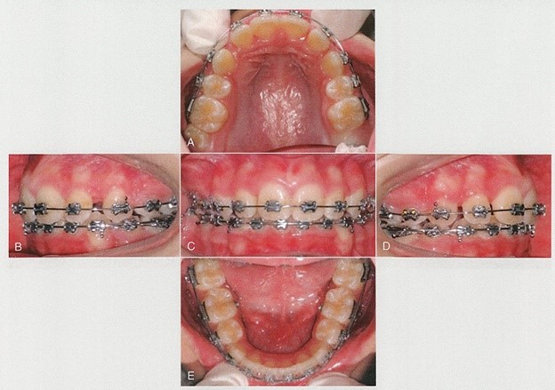 داخل دهان درمان ارتودنسی شلوغی