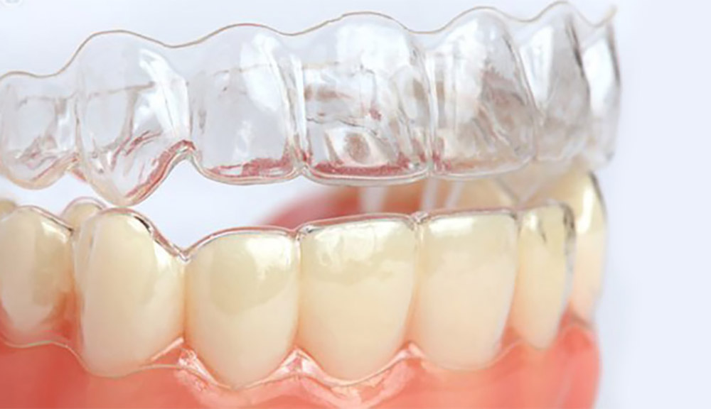 تصویر ارتودنسی نامرئی بر روی دندان