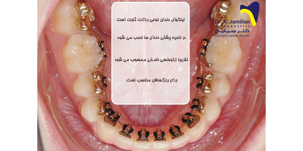 موقعیت لینگوال دندان