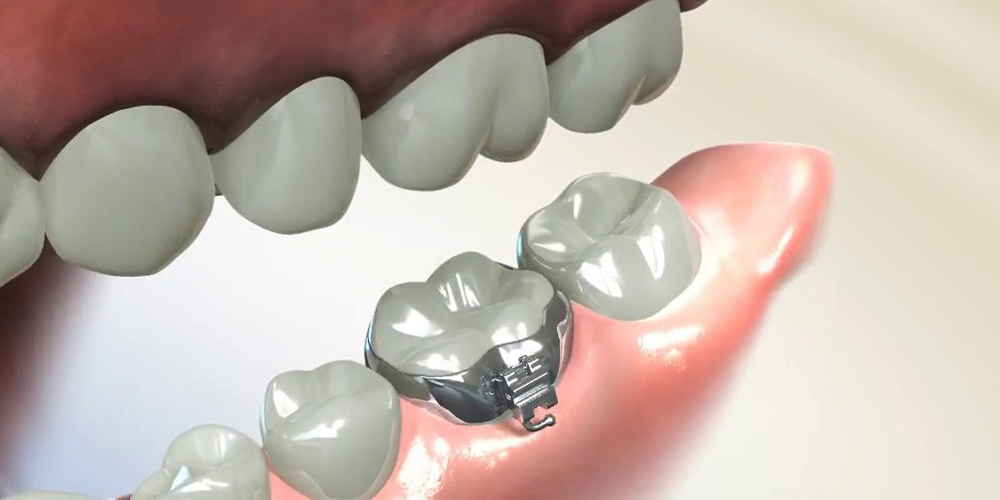 installation of orthodontic bonding