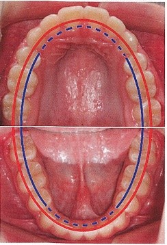 کشیدن دندان های پریمولر