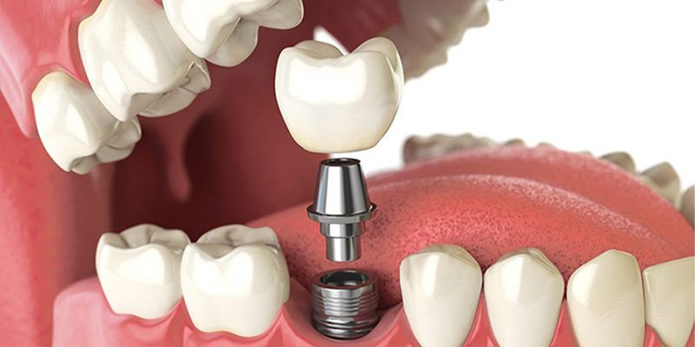اولویت ایمپلنت دندان