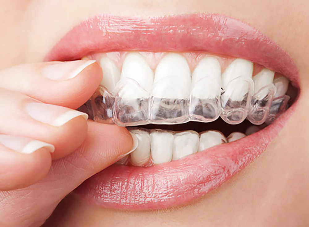 گذاشتن ارتودنسی نامرئی بر روی دندان ها