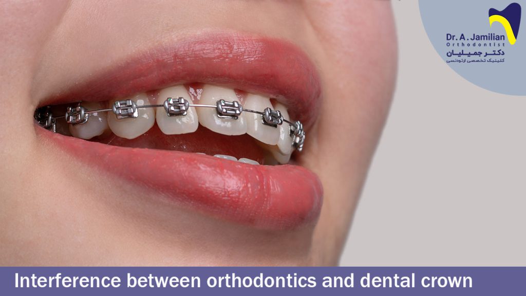 Interference Between Orthodontics And Dental Crowns Dr Jamilian