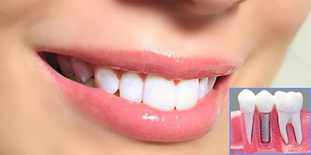 شرایط ایمپلنت دندان چیست