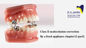 تصحیح مال اکلوژن کلاس II با دستگاه ثابت قسمت2