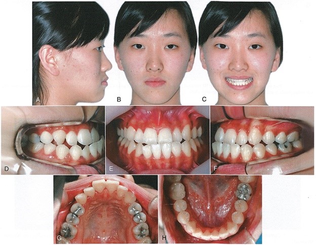 کراس بایت و خط میانی دندان نامنظم
