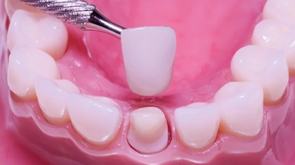 وضع تلبيسة الأسنان من قبل طبيب الأسنان على نسخة السن