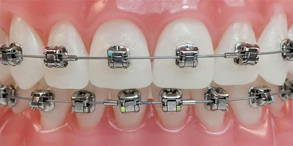 damon orthodontics method