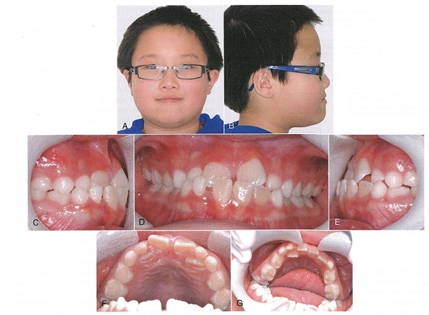 قبل درمان کراس بایت قدامی دندان