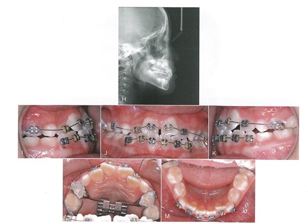 حین درمان کراس بایت قدامی دندان