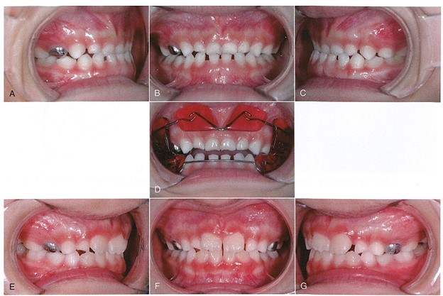 کراس بایت دندانی در طول درمان