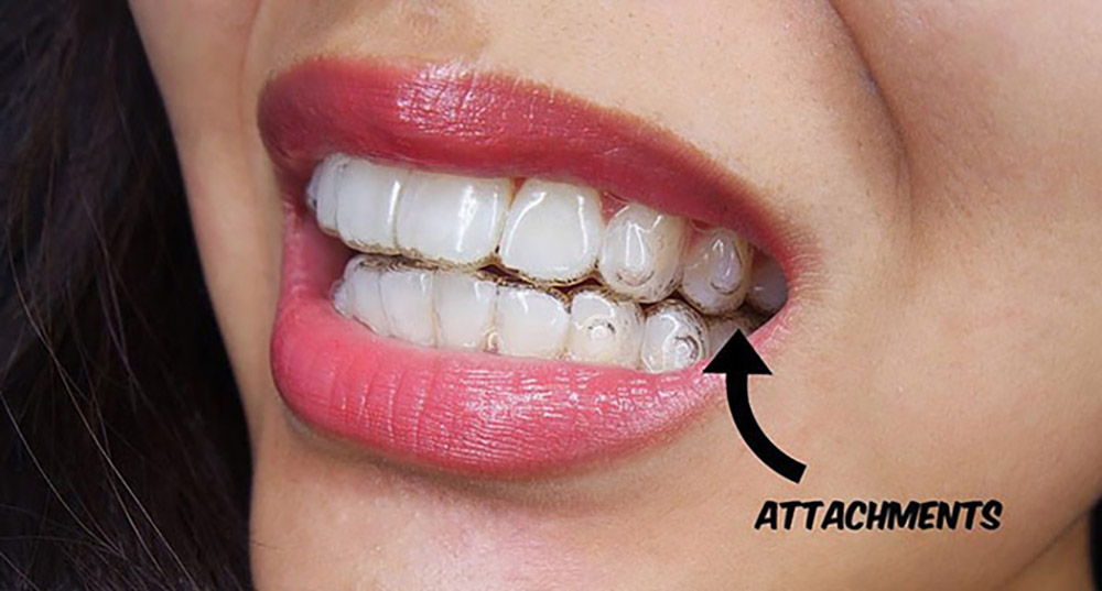 the advantage of transparent, invisible orthodontics