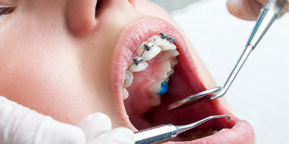 معاینه دندان های تحت درمان ارتودنسی