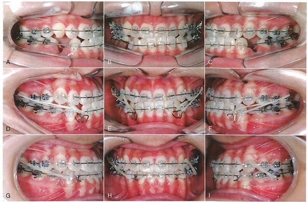 تصیحح خط میانی دندان