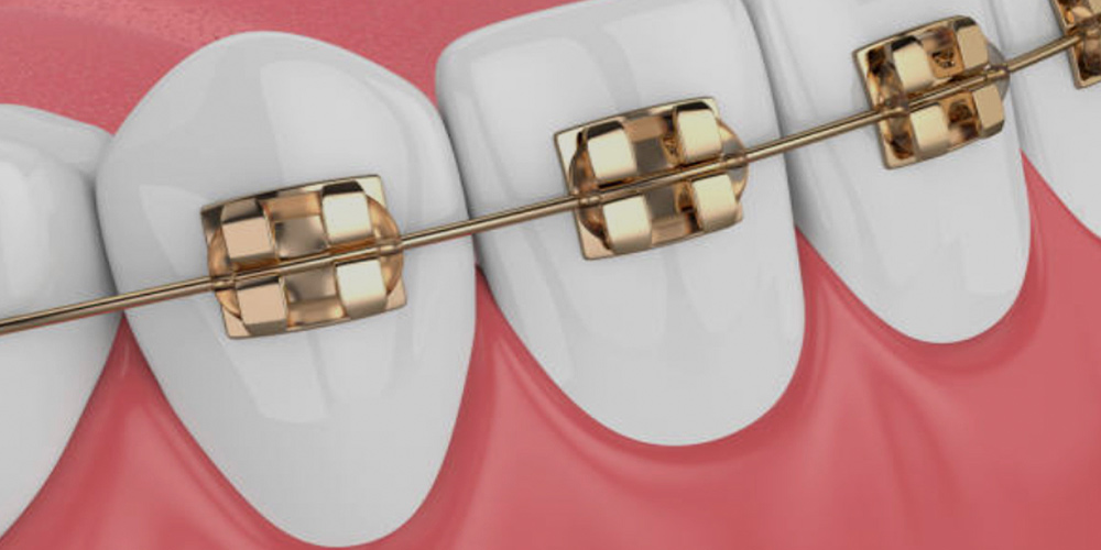 سلك تقويم الأسنان على أسنان الإنسان
