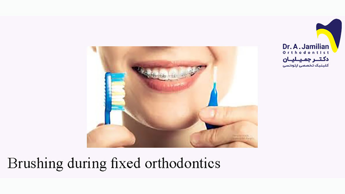 Brushing During Fixed Orthodontics Dr Jamilian
