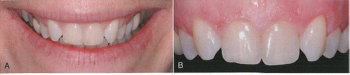 بستن فضای بین دندانها با ارتودنسی