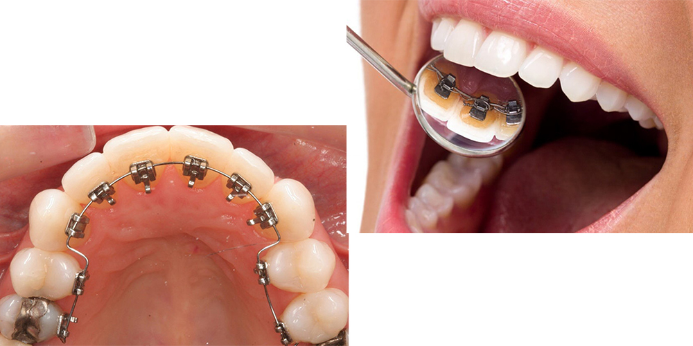 a woman with lingual orthodontic bracket