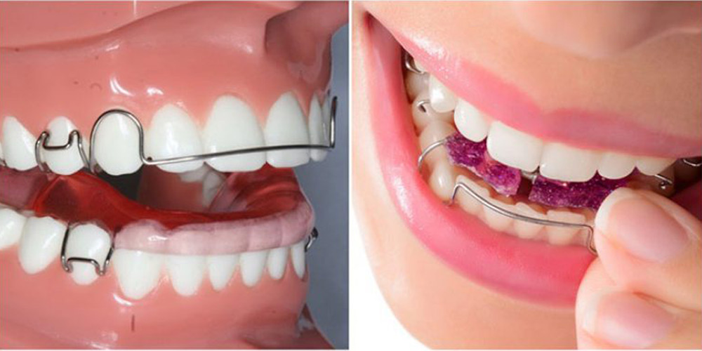 امرأة مع تقويم الأسنان الفك السفلي القابل للإزالة