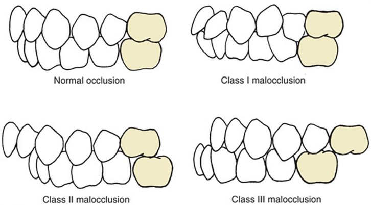 What Is Malocclusion In Orthodontics? - Dr Jamilian