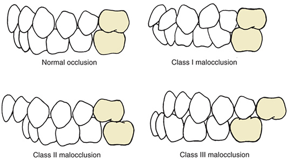 malocclusion classification
