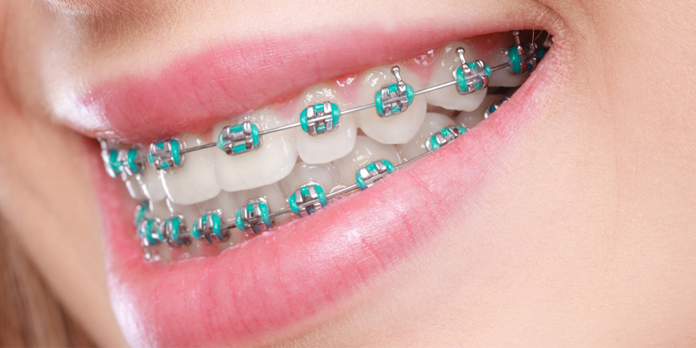a woman with a metal orthodontic bracket
