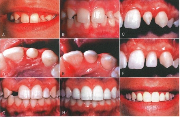 درمان دندان غیب با ارتودنسی ایمپلنت