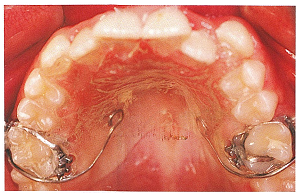 دستگاه ارتودنسی داخل دهانی تثبیت کننده